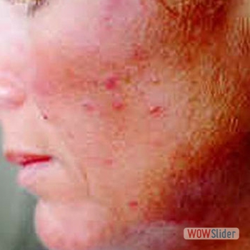 Acne_cheack