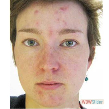 acneface