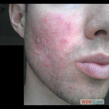 Demodecosis_cheek