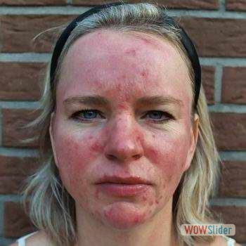 demodicosis