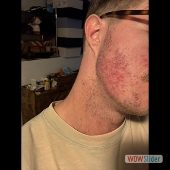 Demodicosis_cheek