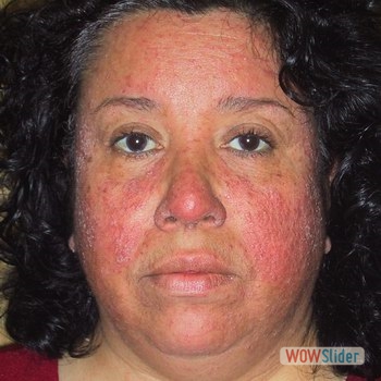 Rosacea_demodicosis